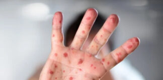 Viruela del mono, un virus en expansión con posibilidades de llegar a Honduras