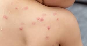 Autoridades de EEUU confirman hasta ahora 12 casos de viruela del mono