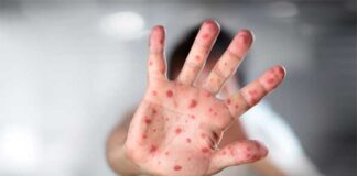 Honduras se declara en vigilancia permanente por viruela del mono