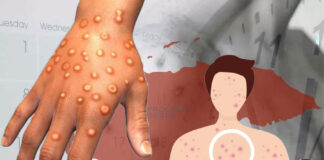 Viruela del mono arriba a Honduras 29 meses después de la COVID-19