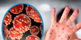 Costa Rica registra primera muerte de un paciente con viruela del mono